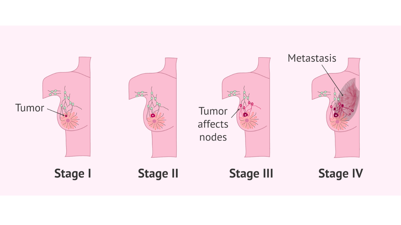stages-of-breast-cancer